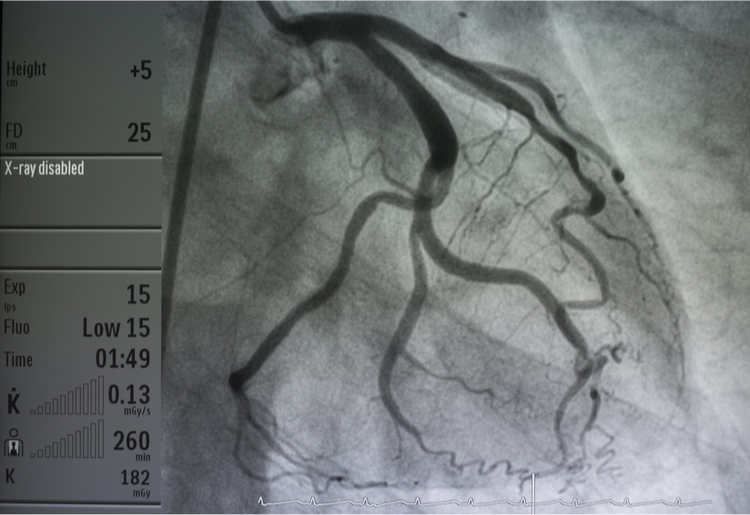 Coronary arteries on an X-ray – diagnosis of heart disease and blood flow