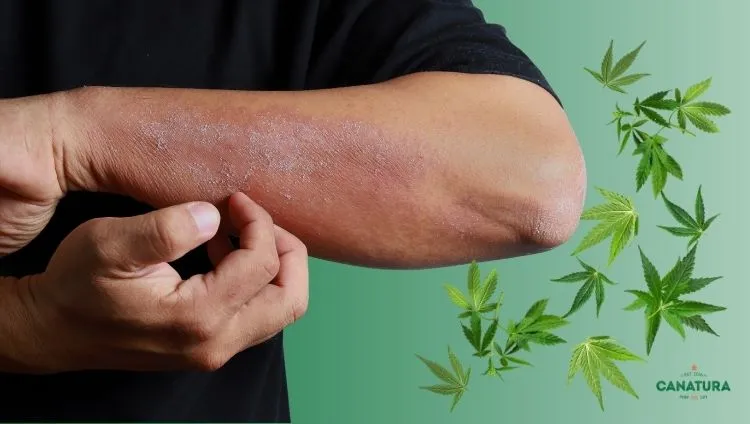 A man with dry, flaky skin on his hands—what dry skin looks like and its typical symptoms, such as flaking, itching, and irritation; industrial hemp leaves; the Canatura logo at the bottom right