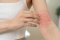 A person scratching an arm irritated by eczema or an allergic reaction.