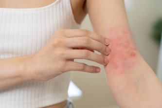 Eine Person kratzt sich am Arm, gereizt durch Ekzem oder allergische Reaktion. Eine Person kratzt sich am Arm, gereizt durch Ekzem oder allergische Reaktion.
