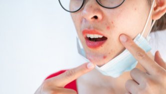 Kann CBD helfen, Akne loszuwerden?