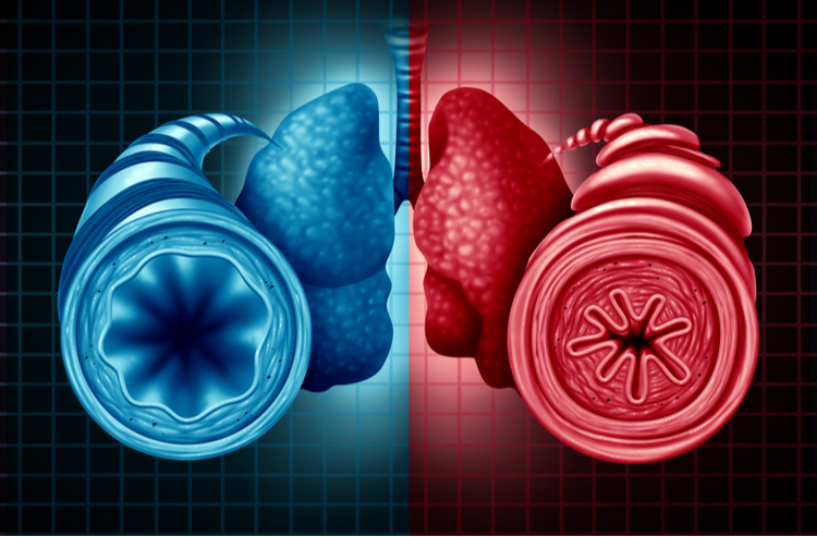 Illustration of healthy (blue) and asthma-narrowed (red) bronchi and lungs