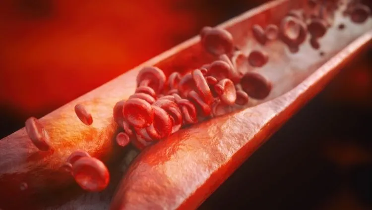 Atherosclerosis – narrowed artery with plaque deposits and red blood cells showing vascular damage in atherosclerosis