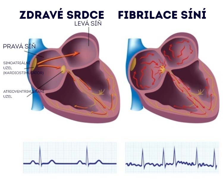 Illustrations of the heart in a healthy state and during atrial fibrillation