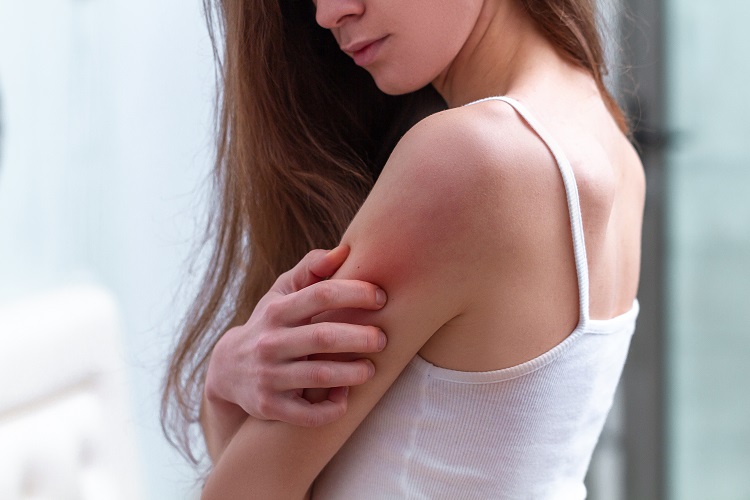 The lady who has a rash on her hand